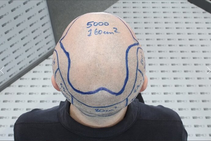 Asmed Clinic - FUE Hair Transplant - 5041 Grafts photo