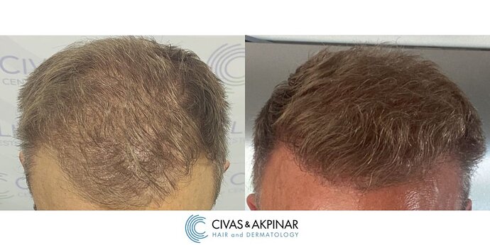 Civas&Akpınar Hair Transplant- FUE Hair Transplant Before & After Pictures (3000 Grafts) photo