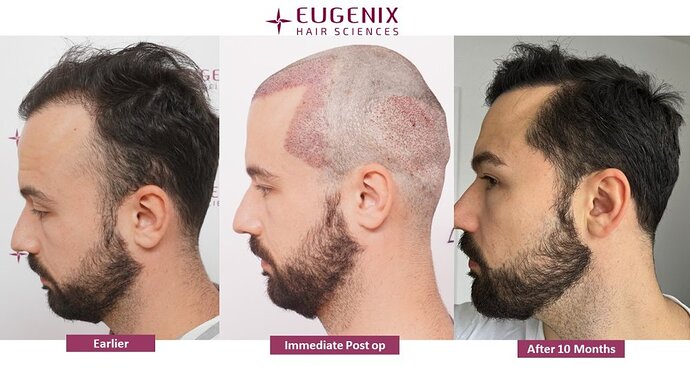 Dr. Somesh| Eugenix Hair Sciences Clinic | NW 3 | 3007 Grafts | 10 Months Post-op photo