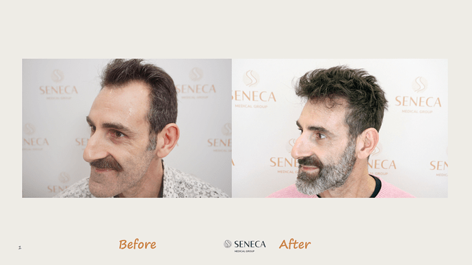 Seneca Medical Group - 1500 grafts with Direct Fue photo
