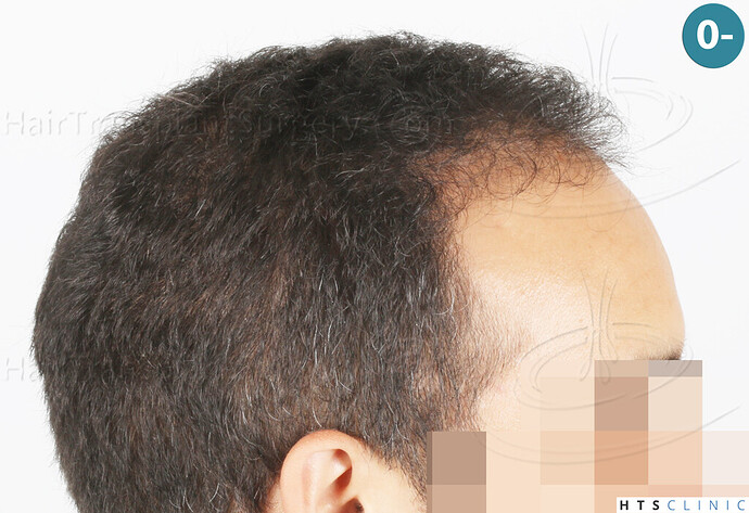 Dr Devroye + Dr Montesanti + Dr Jenard, HTS Clinic / 2018 FUE / Hairline & frontal area photo