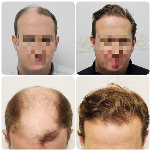 Dr Bonaros, Glasgow, UK / 4013 FUE grafts / 0-12 Months photo