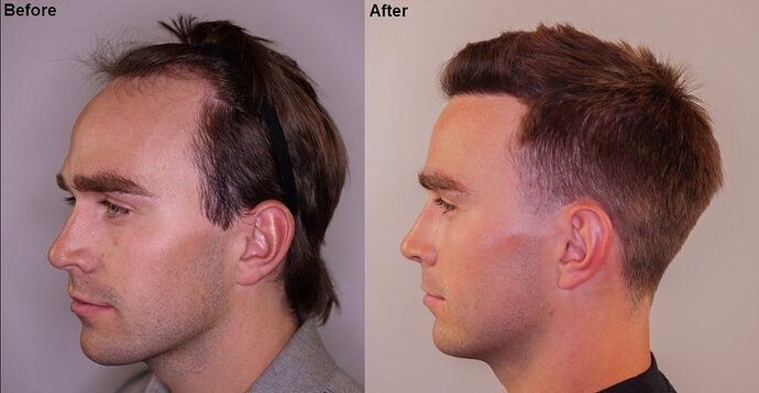 Dr. Barton Hair Transplant Result 2,500 grafts photo