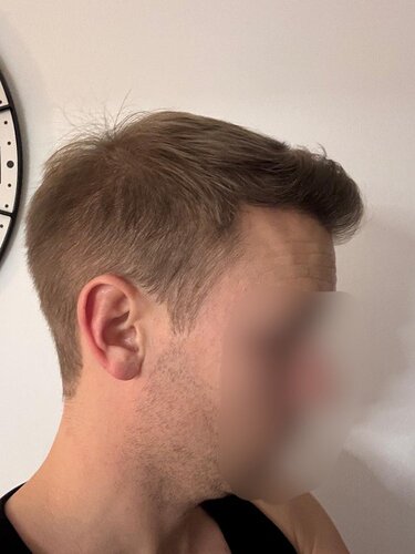 Ozlem Bicer MD-Hair Transplant-2720 Grafts FUE by micro-motor, 9. months result photo