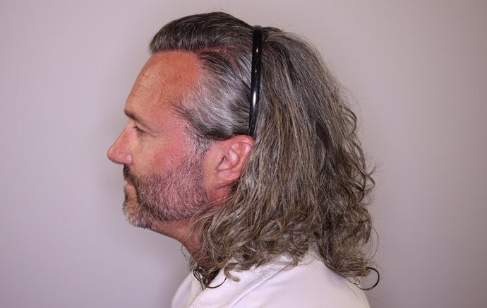 Utah Hair Restoration - Dr. Barton alviarmani photo