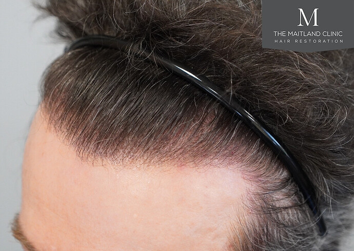 Before and after results: 1694 grafts by FUE at The Maitland Clinic (Dr Edward Maitland Ball) photo