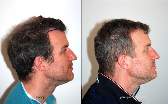 Case performed by Dr. Feriduni – 3883 FU in 1 procedure photo