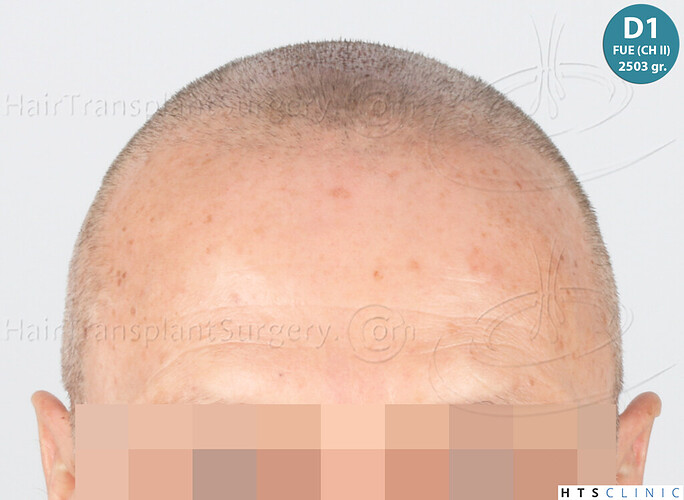 Dr Devroye + Dr Montesanti + Dr Jenard / 7015 grafts (4512 FUT + 2503 FUE) / 2 sessions photo