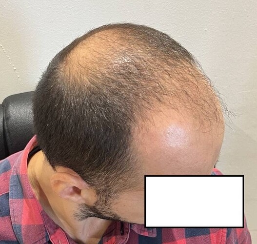 Two FUE Surgeries Totaling 6560 Grafts – HDC Hair Clinic photo