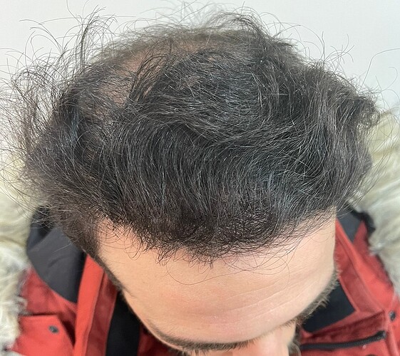 Hair Transplant Result - 15 months after for 4000 FUE Grafts on NW5 Patient – HDC hair Clinic – Dr Maras photo