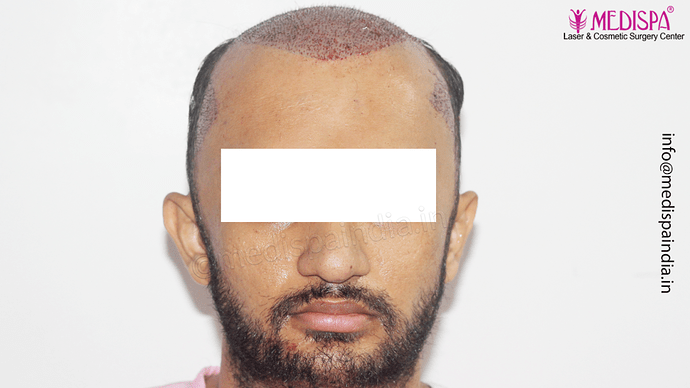 Dr. Suneet Soni - 4665 Grafts, Combine FUT + FUE + BHT (Beard) Technique photo