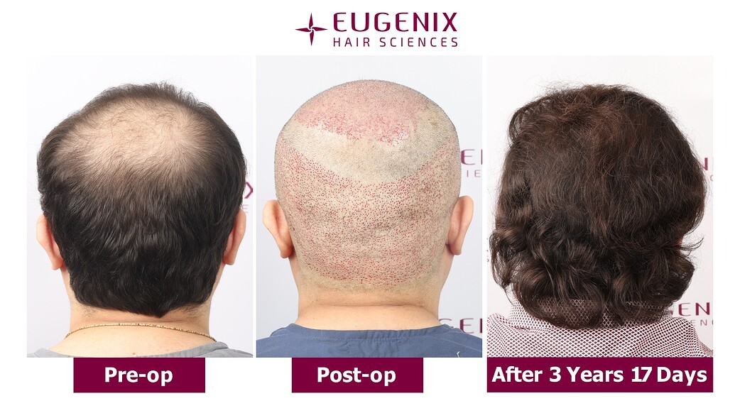 https://cdn.forumhairtransplant.com/optimized/3X/6/3/63182041a3b4f3c3f701c834f9fcb3b10c6835f7_2_1035x582.jpeg