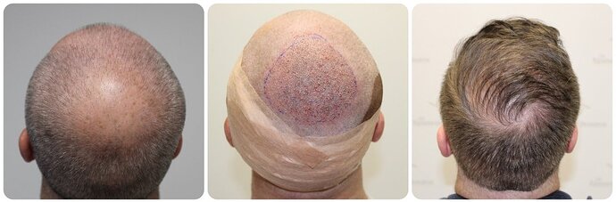 Dr Bonaros, Glasgow, UK / 4076 FUE grafts / 0-12 Months photo