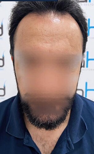 DR HAKAN DOGANAY/ 2000 GRAFTS / Implanter Pen+FUE photo