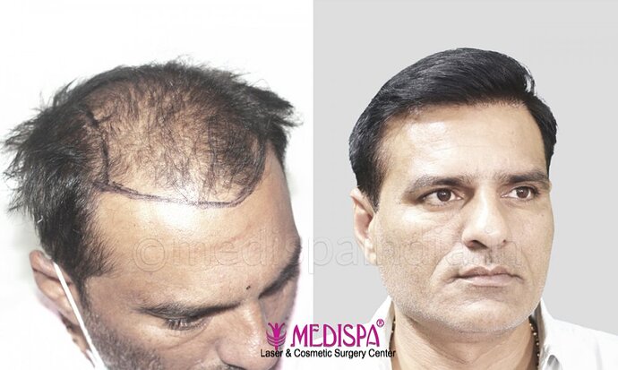 Dr. Suneet Soni - 5000 Grafts, Combine FUT + FUE + Beard, Natural Hairline photo