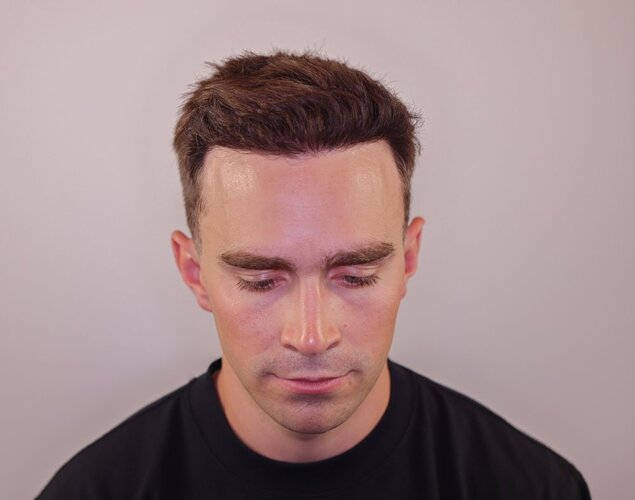 Dr. Barton Hair Transplant Result 2,500 grafts photo