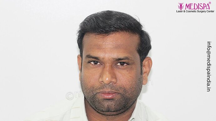 Dr. Suneet Soni - 5498 Grafts, 2 Years Result, Combine FUT + FUE + Beard Technique, NW-VI photo