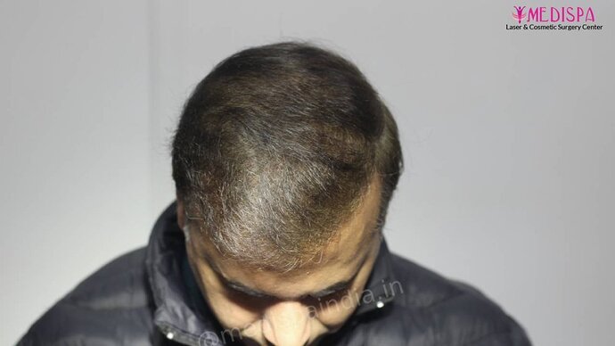 11600 Grafts in 3 FUT Sittings by Dr Suneet Soni photo