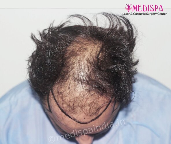 Dr. Suneet Soni - 5000 Grafts, Combine FUT + FUE + BHT (Beard) Technique, NW-V, 2.5 Year Result photo