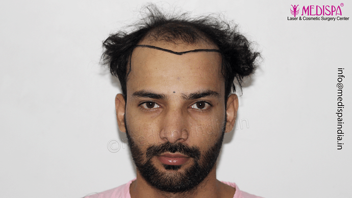 Dr. Suneet Soni - 4046 Grafts | 12-Month Result | Combination FUT + FUE + Beard photo