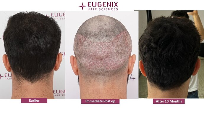 Dr. Somesh| Eugenix Hair Sciences Clinic | NW 3 | 3007 Grafts | 10 Months Post-op photo