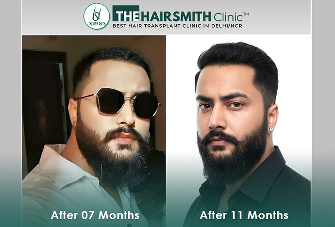The HairSmith Clinic Delhi | NW Stage 6 | 3785 Grafts | 11 Months Hair Transplant Result photo