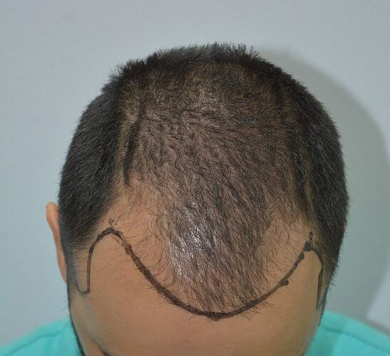 DR HAKAN DOGANAY/ 3500 GRAFTS / After 3 Years/ Implanter Pen+FUE photo