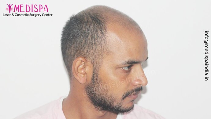 Dr. Suneet Soni - 5294 Grafts, Combine FUT + FUE + Beard Technique, NW- VI, 2 Years Result photo