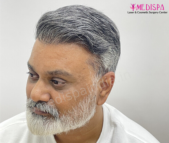 Dr. Suneet Soni - 4190 Grafts, Combine FUT + FUE + Beard Technique, NW- III photo