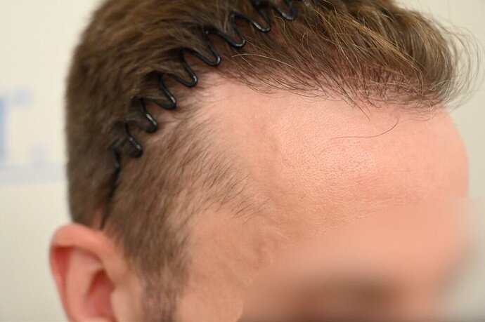 Ozlem Bicer MD-2340 Grafts FUE by micro-motor, 12. month result  photo