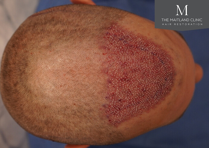1826 grafts by FUE with Dr Edward Maitland Ball at The Maitland Clinic photo