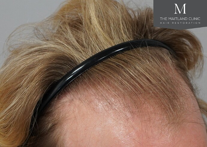 Dr. Ball The Maitland Clinic 1800 Graft FUE Hair Transplant photo