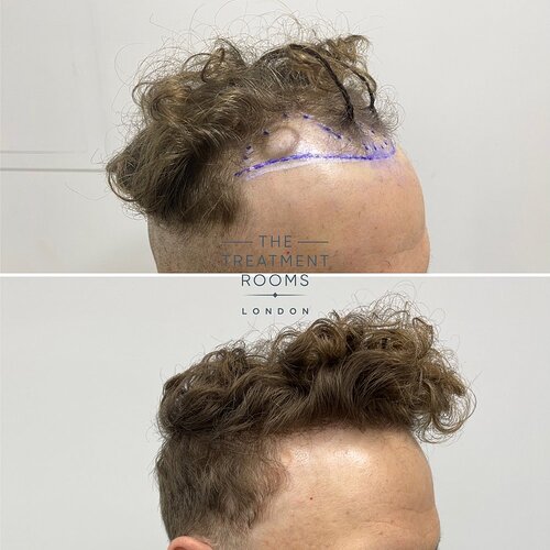 1514 Grafts Hairline Hair Transplant- The Treatment Rooms London photo