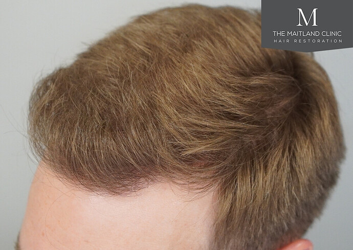 1826 grafts by FUE with Dr Edward Maitland Ball at The Maitland Clinic photo