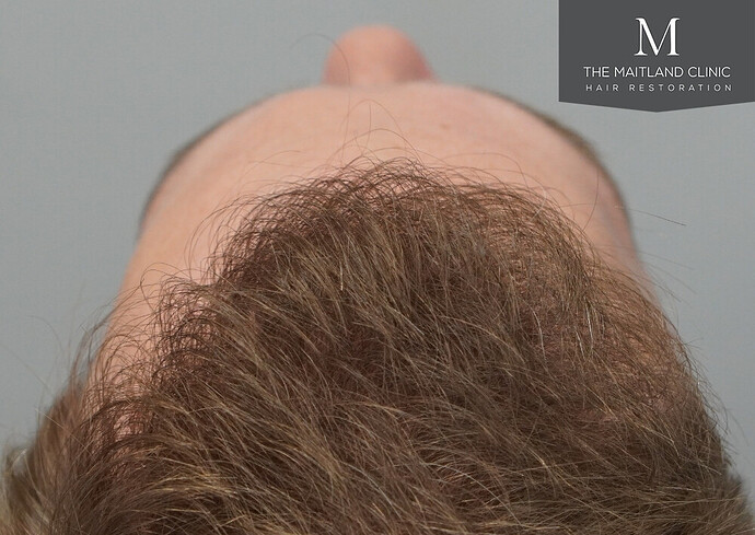 1826 grafts by FUE with Dr Edward Maitland Ball at The Maitland Clinic photo