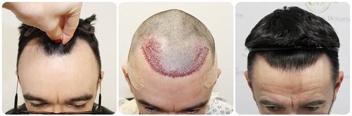 Dr Bonaros, Glasgow, UK / 1816 FUE grafts / 0-12 Months photo