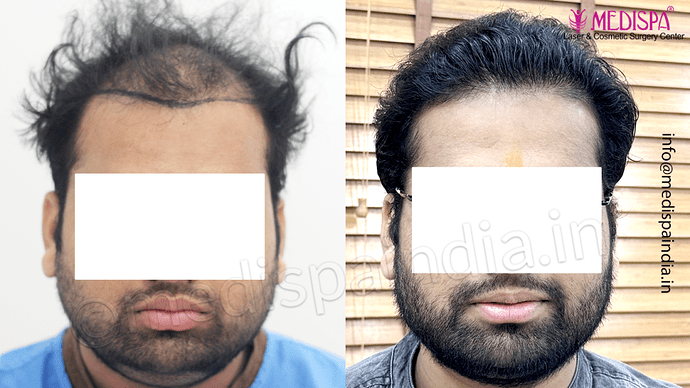 Dr. Suneet Soni - 5467 Grafts, Combine FUT + FUE + Beard Technique, NW- V, 3 Years Result photo