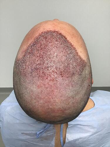 Dr. Bisanga & Dr. Kostis - 3000 FUE 0 - 12 Months photo