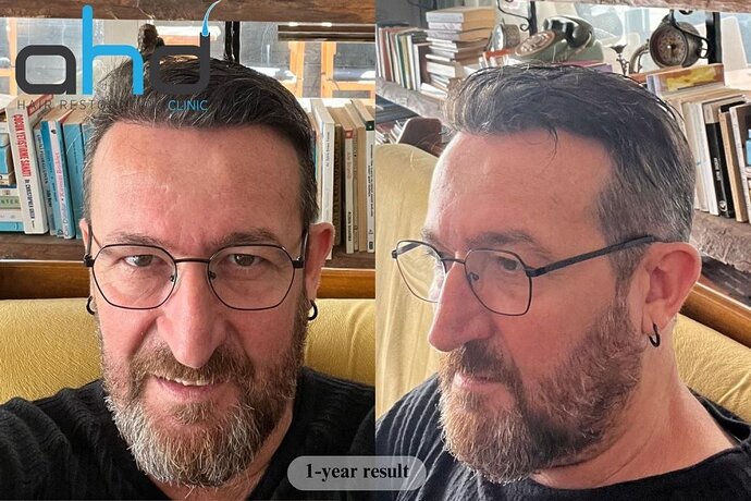 AHD Clinic / Dr.Hakan Doganay's Team / DHI + FUE/ 3500 grafts photo