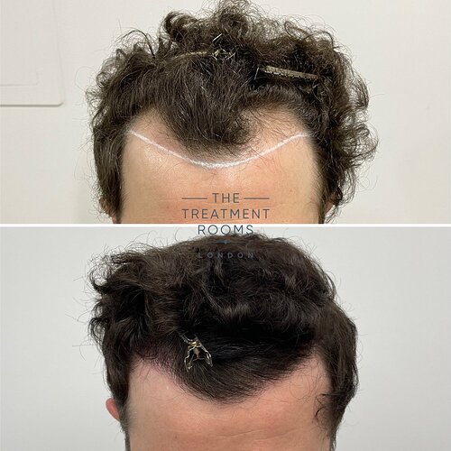FUE Hairline Restoration 1306 Grafts- The Treatment Rooms London photo