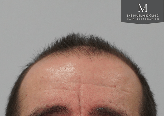 Dr Ball - The Maitland Clinic 3803 Grafts By FUT photo