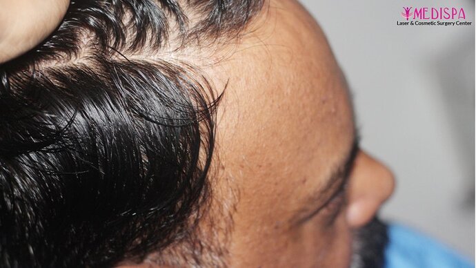 Dr. Suneet Soni - 4190 Grafts, Combine FUT + FUE + Beard Technique, NW- III photo