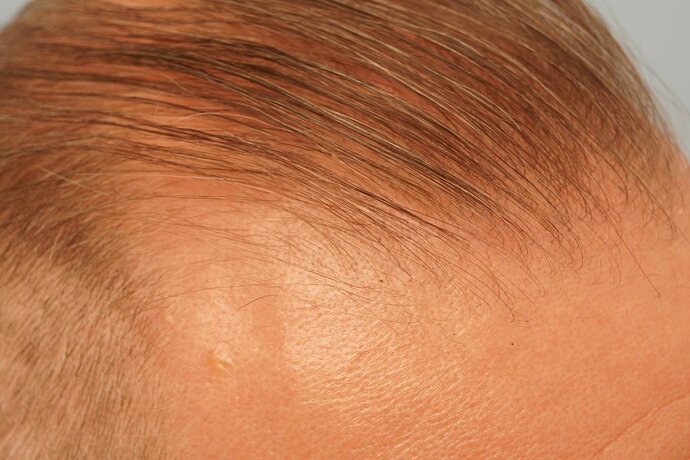 Dr B Farjo 1700g FUE (Front) photo