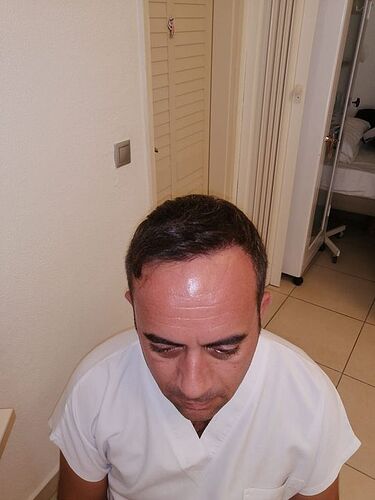 DR HAKAN DOGANAY/ 3625 GRAFTS (3000 from head + 625 from beard) / Implanter Pen+FUE photo