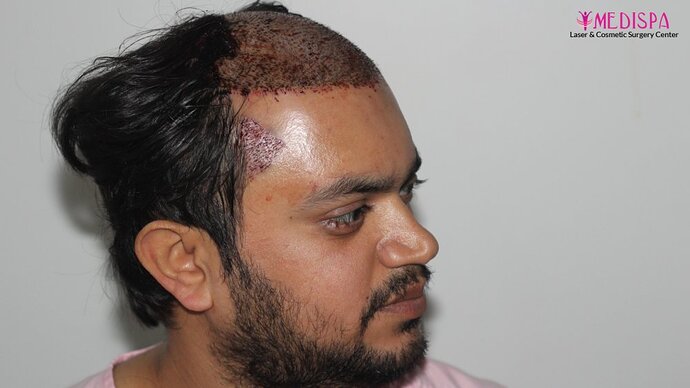 Dr. Suneet Soni - 4937 Grafts, Combine FUT + FUE Technique, NW : IV-V photo