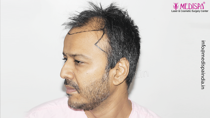 Dr. Suneet Soni - 4889 Grafts | 2.5 Years Result | Combination FUT + FUE + Beard photo