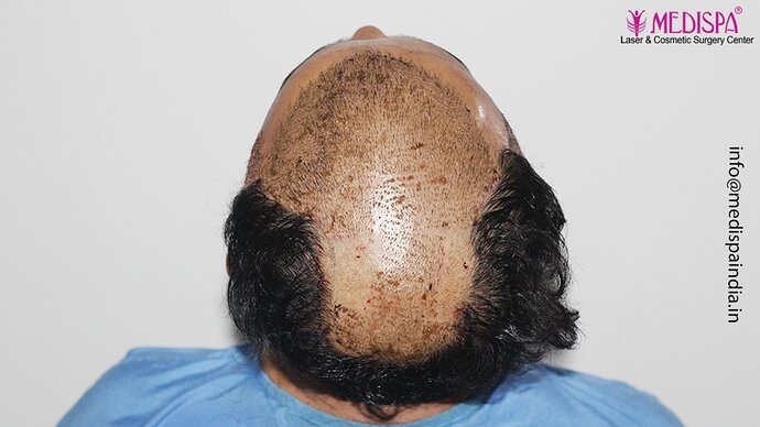 Dr. Suneet Soni - 5000 Grafts, Combine FUT + FUE + Beard Technique, NW-V photo