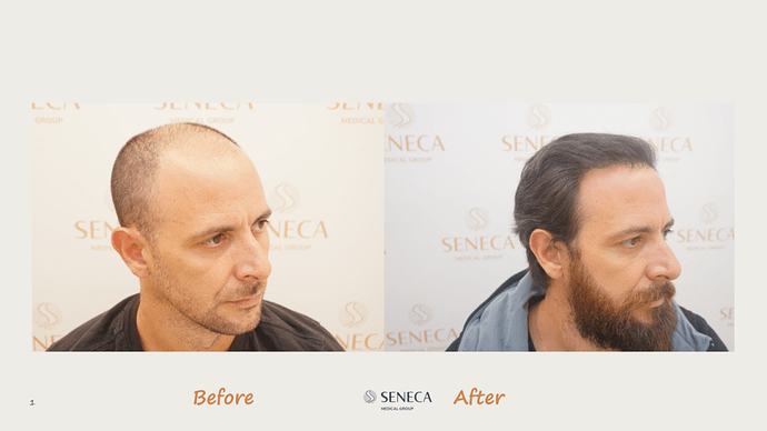 Seneca Medical Group - 3612 grafts with Direct Fue photo