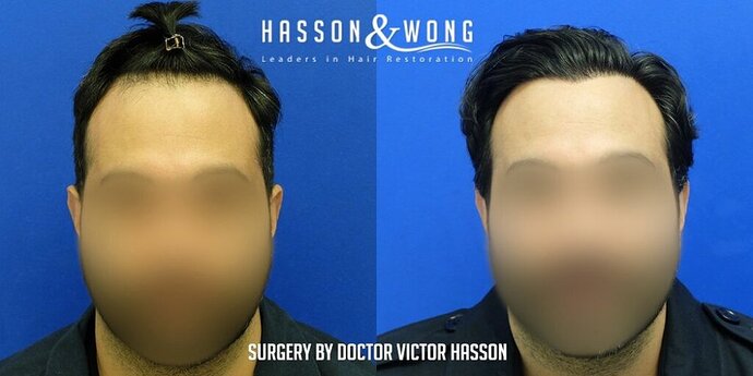 Dr. Hasson / 2,500 grafts / FUE / Hairline / 1 Year Post-op photo