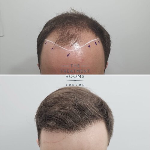 Result- Frontal Third FUE Hair Transplant- 2187 Grafts photo